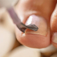 Vernis Mycose Ongles