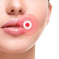 Herpès Labial